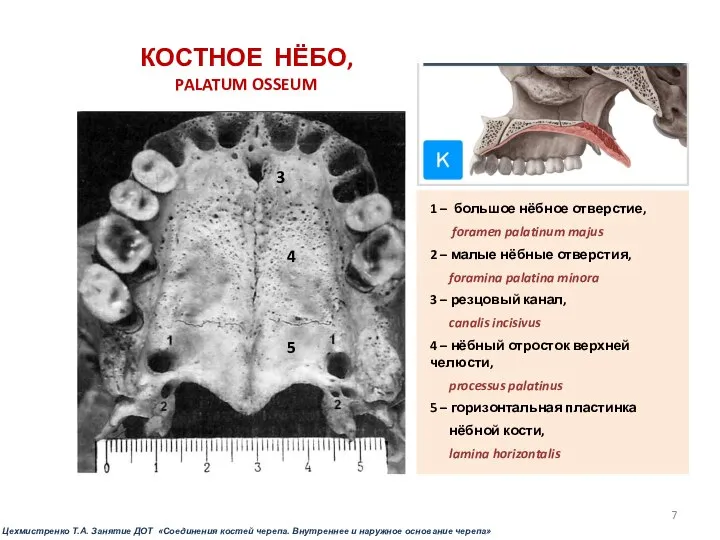 КОСТНОЕ НЁБО, PALATUM OSSEUM 1 – большое нёбное отверстие, foramen palatinum majus