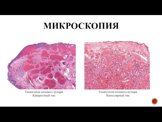 МИКРОСКОПИЯ Гемангиома мочевого пузыря. Капиллярный тип. Гемангиома мочевого пузыря. Кавернозный тип.