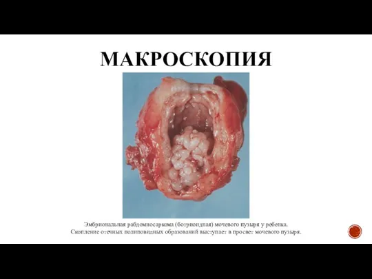 МАКРОСКОПИЯ Эмбриональная рабдомиосаркома (ботриоидная) мочевого пузыря у ребенка. Скопление отечных полиповидных образований