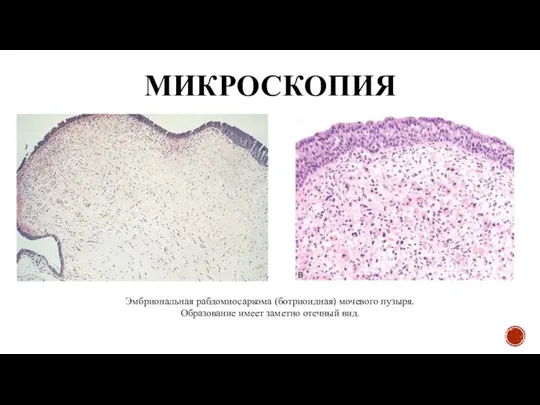 МИКРОСКОПИЯ Эмбриональная рабдомиосаркома (ботриоидная) мочевого пузыря. Образование имеет заметно отечный вид.