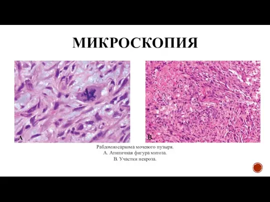 МИКРОСКОПИЯ Рабдомиосаркома мочевого пузыря. А. Атипичная фигура митоза. В. Участки некроза. А В