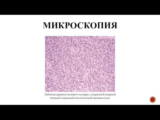 МИКРОСКОПИЯ Лейомиосаркома мочевого пузыря с умеренной ядерной атипией и высокой митотической активностью.