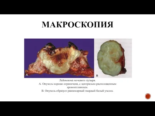 МАКРОСКОПИЯ Лейомиома мочевого пузыря. А. Опухоль хорошо ограничена, с центрально расположенным кровоизлиянием.