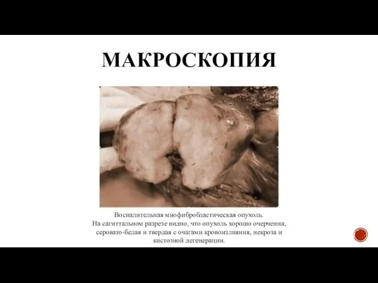 МАКРОСКОПИЯ Воспалительная миофибробластическая опухоль. На сагиттальном разрезе видно, что опухоль хорошо очерченна,