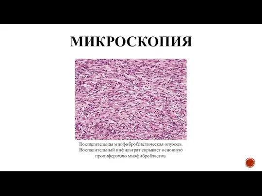 МИКРОСКОПИЯ Воспалительная миофибробластическая опухоль. Воспалительный инфильтрат скрывает основную пролиферацию миофибробластов.