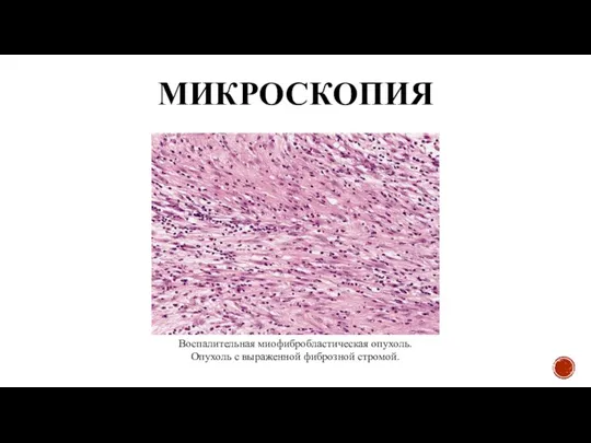 МИКРОСКОПИЯ Воспалительная миофибробластическая опухоль. Опухоль с выраженной фиброзной стромой.