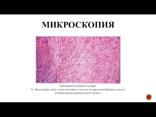 МИКРОСКОПИЯ Лейомиома мочевого пузыря. А. Опухолевая ткань гипоклеточная и состоит из веретенообразных