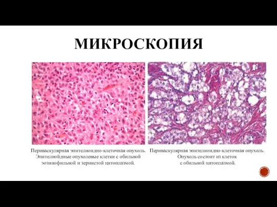 МИКРОСКОПИЯ Периваскулярная эпителиоидно-клеточная опухоль. Эпителиойдные опухолевые клетки с обильной эозинофильной и зернистой