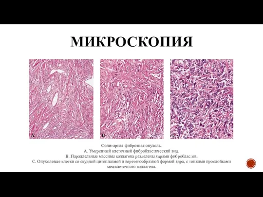 МИКРОСКОПИЯ Солитарная фиброзная опухоль. А. Умеренный клеточный фибробластический вид. В. Параллельные массивы