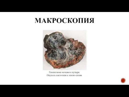 МАКРОСКОПИЯ Гемангиома мочевого пузыря. Опухоль кистозная и темно-синяя.