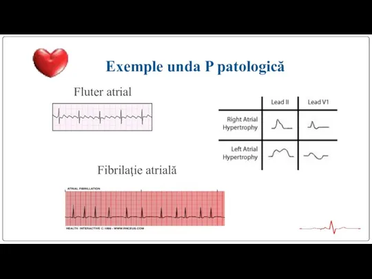 Exemple unda P patologică Fluter atrial Fibrilaţie atrială