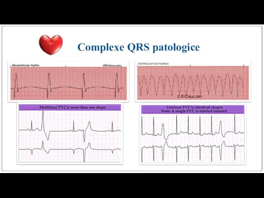 Complexe QRS patologice