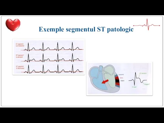 Exemple segmentul ST patologic
