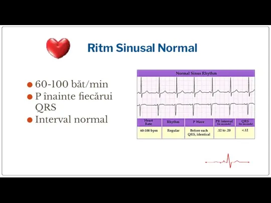 Ritm Sinusal Normal 60-100 băt/min P înainte fiecărui QRS Interval normal
