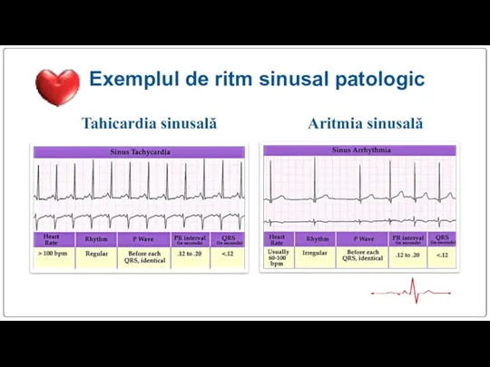 Exemplul de ritm sinusal patologic Tahicardia sinusală Aritmia sinusală