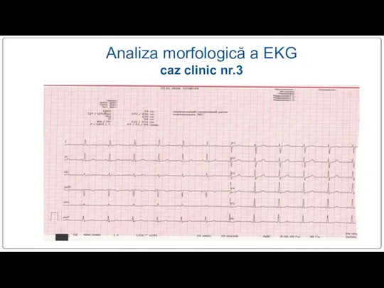 Analiza morfologică a EKG caz clinic nr.3