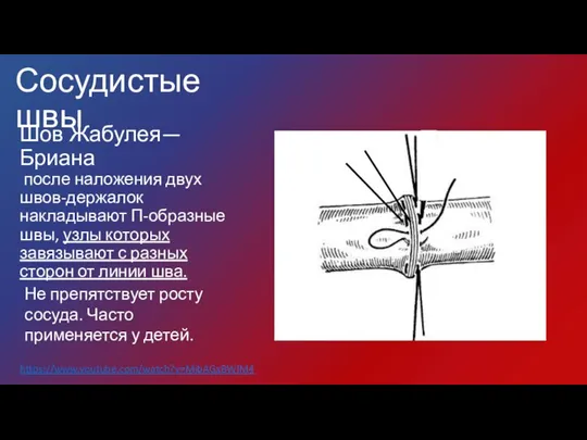 Шов Жабулея—Бриана после наложения двух швов-держалок накладывают П-образные швы, узлы которых завязывают