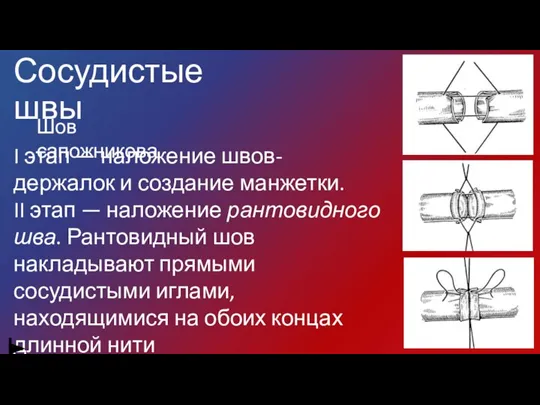 Сосудистые швы Шов сапожникова I этап — наложение швов-держалок и создание манжетки.