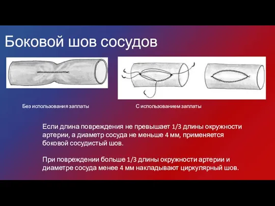 Боковой шов сосудов Без использования заплаты С использованием заплаты Если длина повреждения