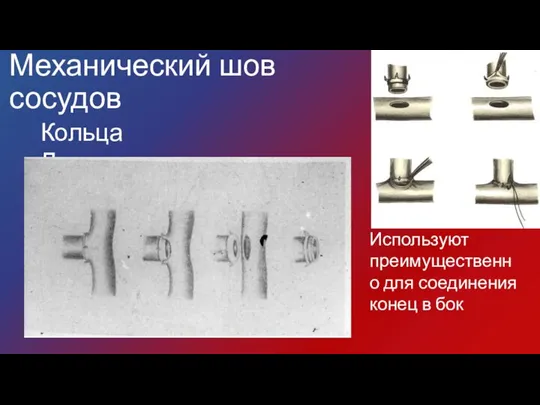 Механический шов сосудов Кольца Донецкого Используют преимущественно для соединения конец в бок