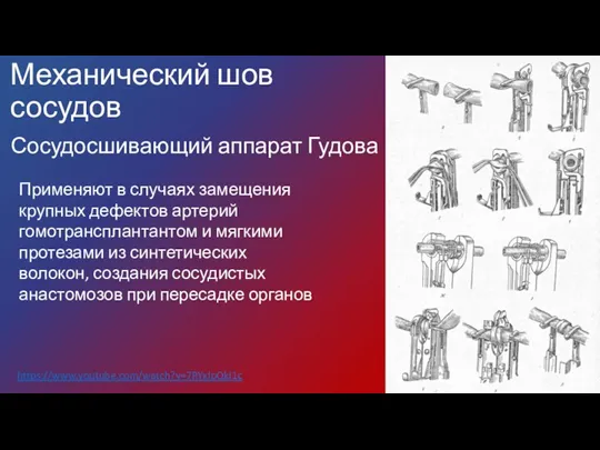 Механический шов сосудов Сосудосшивающий аппарат Гудова https://www.youtube.com/watch?v=7RYxIpQki1c Применяют в случаях замещения крупных