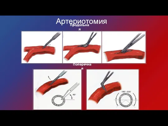 Артериотомия Продольная Поперечная