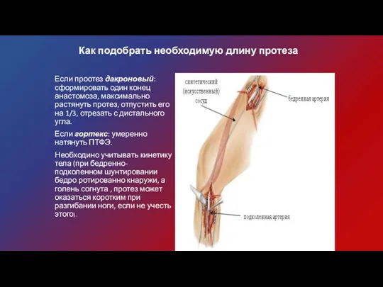 Как подобрать необходимую длину протеза Если проотез дакроновый: сформировать один конец анастомоза,