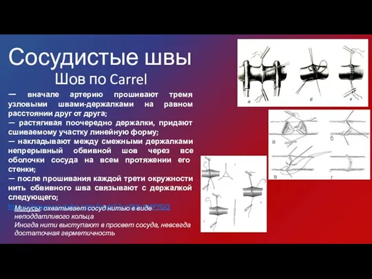 Сосудистые швы Шов по Carrel — вначале артерию прошивают тремя узловыми швами-держалками