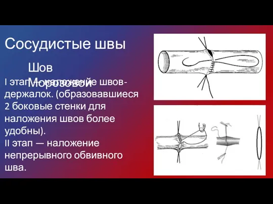 I этап — наложение швов-держалок. (образовавшиеся 2 боковые стенки для наложения швов