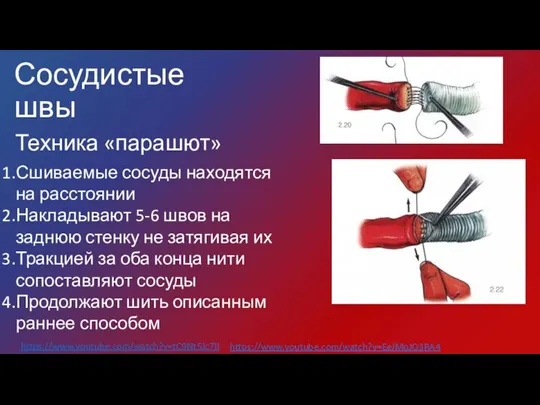 Техника «парашют» Сшиваемые сосуды находятся на расстоянии Накладывают 5-6 швов на заднюю