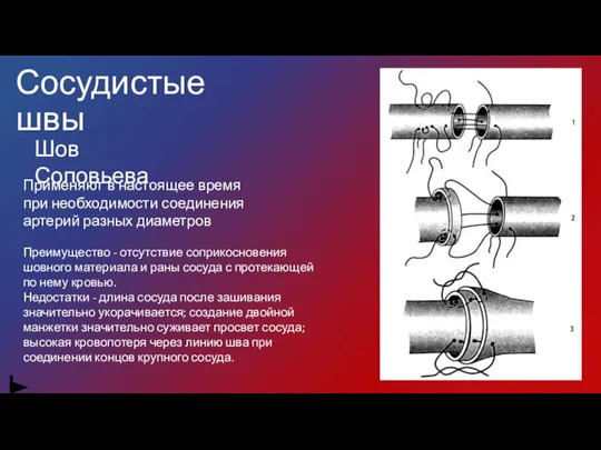 Сосудистые швы Шов Соловьева Применяют в настоящее время при необходимости соединения артерий