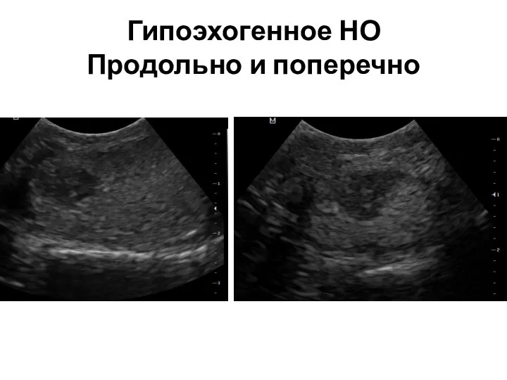 Гипоэхогенное НО Продольно и поперечно