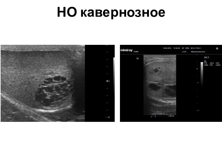 НО кавернозное