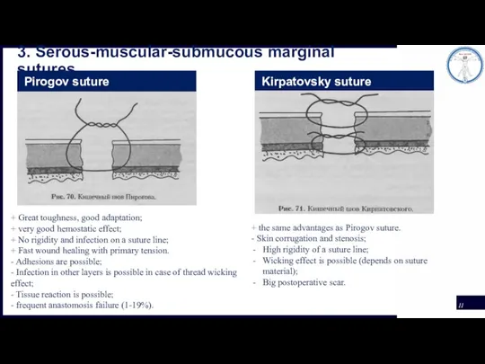 3. Serous-muscular-submucous marginal sutures Pirogov suture Kirpatovsky suture + Great toughness, good