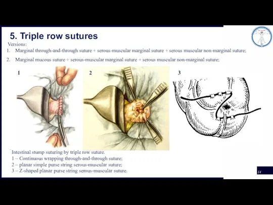 5. Triple row sutures Versions: Marginal through-and-through suture + serous-muscular marginal suture