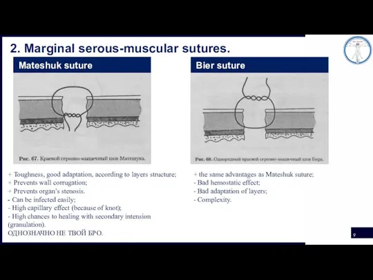 2. Marginal serous-muscular sutures. Mateshuk suture Bier suture + Toughness, good adaptation,