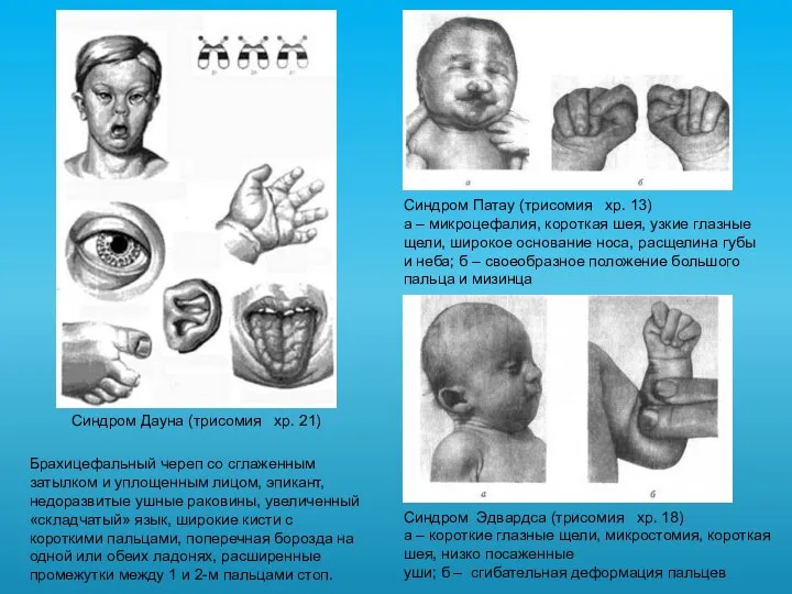 Синдром Патау (трисомия хр. 13) а – микроцефалия, короткая шея, узкие глазные