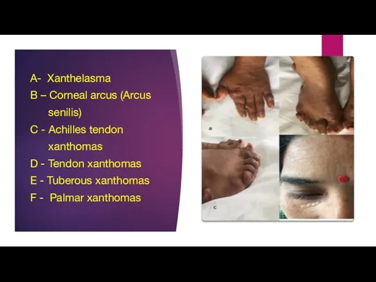 A- Xanthelasma B – Corneal arcus (Arcus senilis) C - Achilles tendon