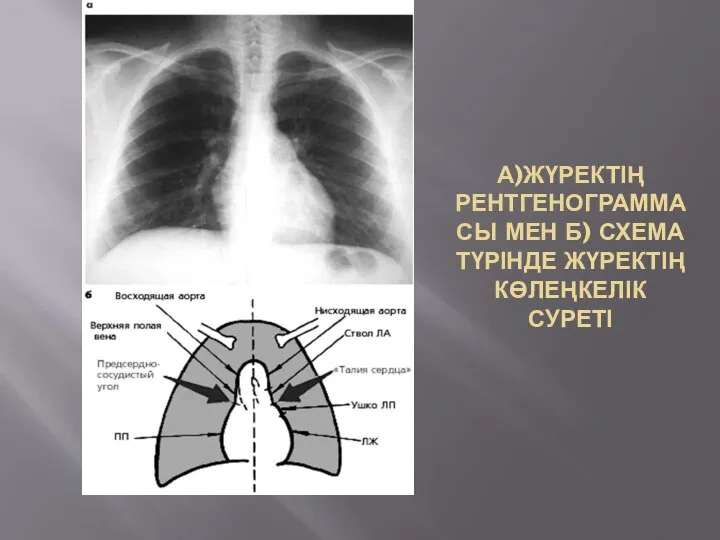 А)ЖҮРЕКТІҢ РЕНТГЕНОГРАММАСЫ МЕН Б) СХЕМА ТҮРІНДЕ ЖҮРЕКТІҢ КӨЛЕҢКЕЛІК СУРЕТІ