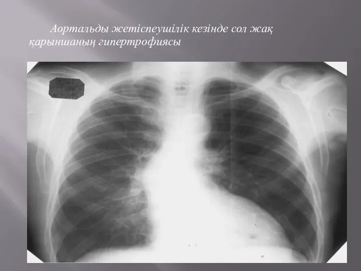 Аортальды жетіспеушілік кезінде сол жақ қарыншаның гипертрофиясы
