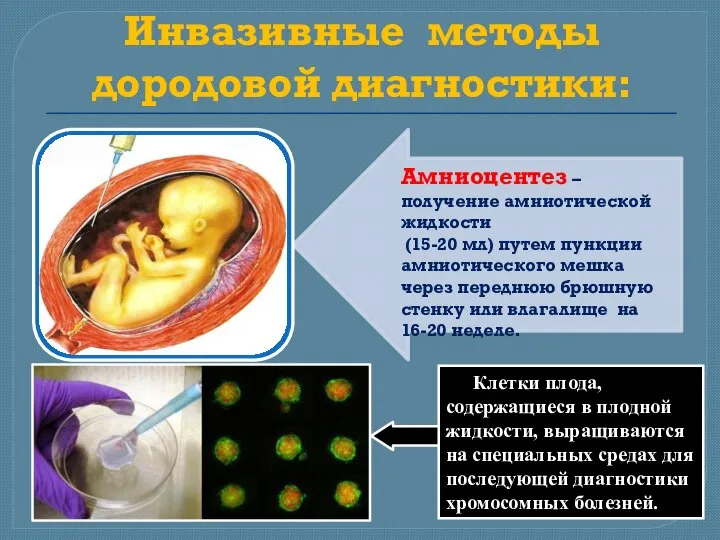 Инвазивные методы дородовой диагностики: Амниоцентез –получение амниотической жидкости (15-20 мл) путем пункции