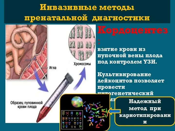 Кордоцентез: взятие крови из пупочной вены плода под контролем УЗИ. Культивирование лейкоцитов