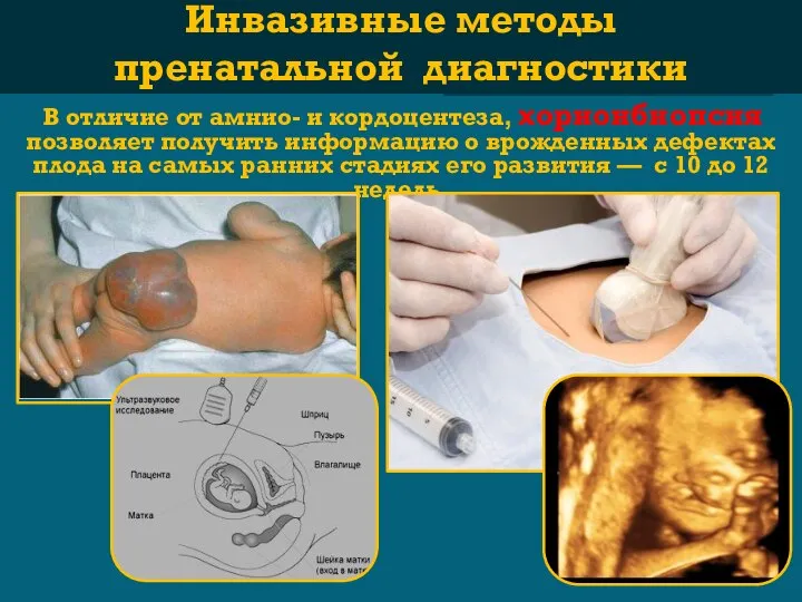 В отличие от амнио- и кордоцентеза, хорионбиопсия позволяет получить информацию о врожденных