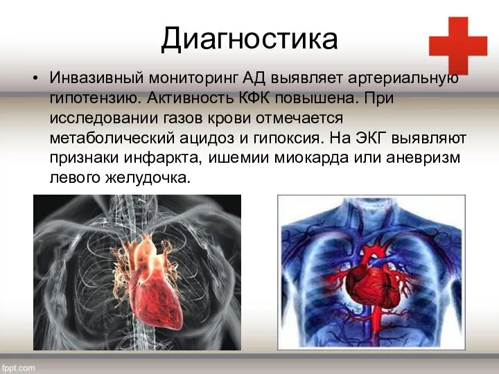 Диагностика Инвазивный мониторинг АД выявляет артериальную гипотензию. Активность КФК повышена. При исследовании