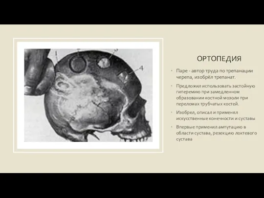 ОРТОПЕДИЯ Паре - автор труда по трепанации черепа, изобрёл трепанат. Предложил использовать