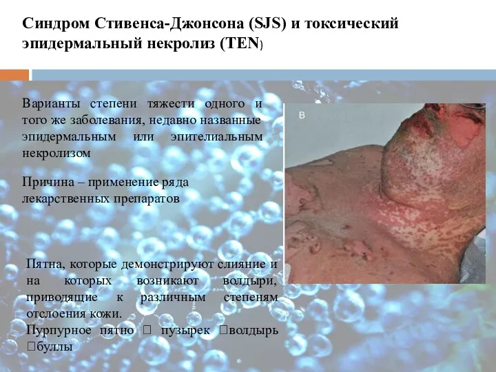 Синдром Стивенса-Джонсона (SJS) и токсический эпидермальный некролиз (TEN) Варианты степени тяжести одного