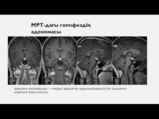 МРТ-дағы гипофиздің аденомасы аденома жағдайында — мидың қоршаған құрылымдарына ісік қысымын азайтуға бағытталған