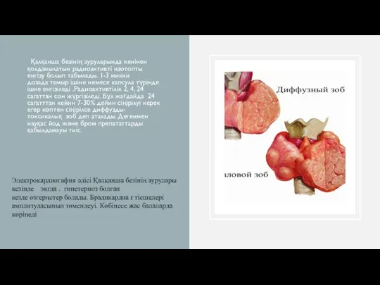 Қалқанша безінің ауруларында кенінен қолданылатын радиоактивті изотопты енгізу болып табылады. 1-3 микки