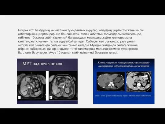 Бүйрек үсті бездерінің қызметінен туындайтын аурулар, олардың қыртысты және милы қабаттарының гормондарына