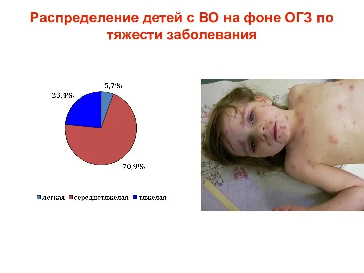 Распределение детей с ВО на фоне ОГЗ по тяжести заболевания